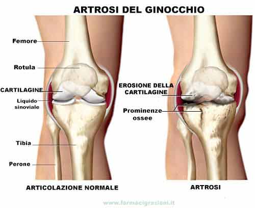 Cartilagine di Squalo per Artrosi del ginocchio