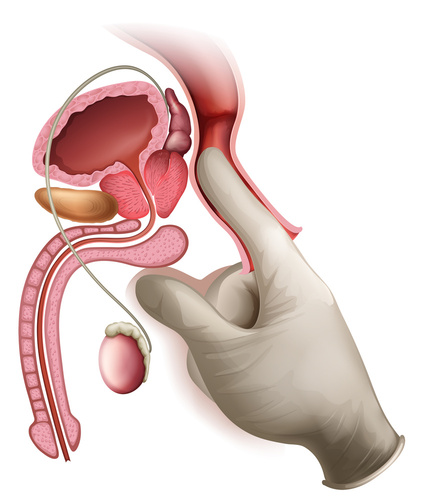 terapia psa prostatica