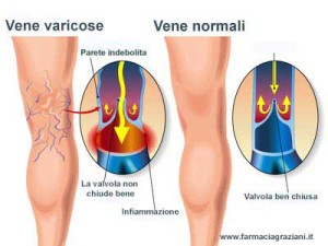 Vene-varicose